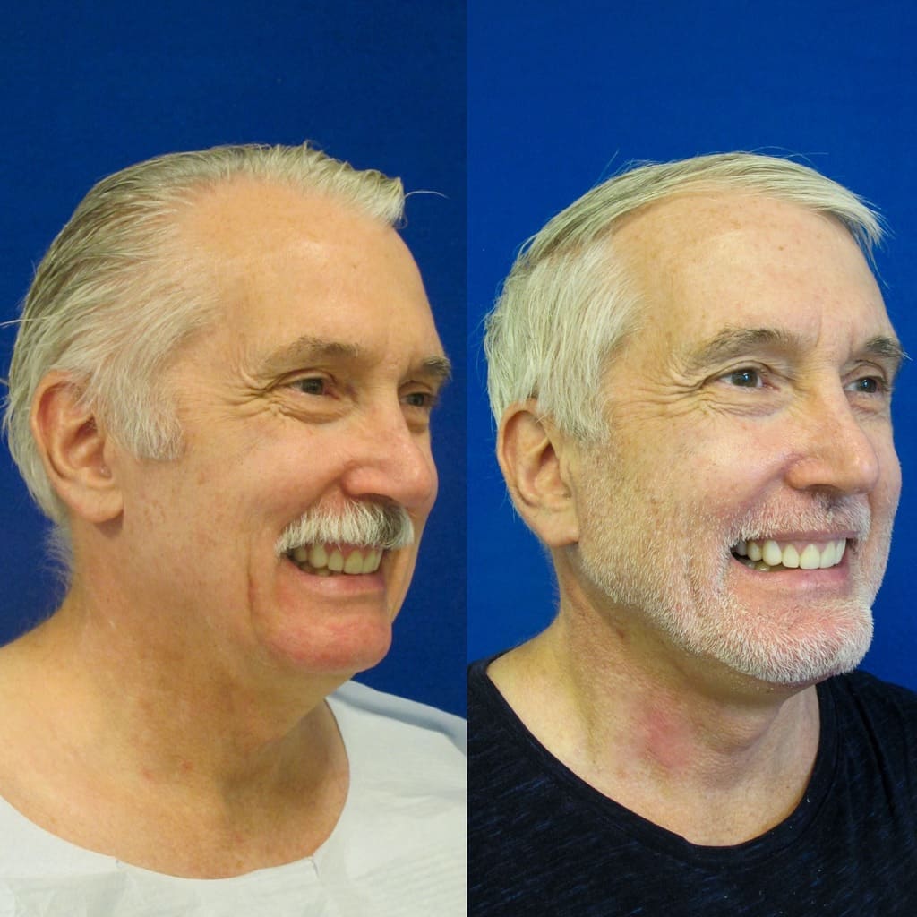 Washington Dc Male Facelift Surgery Before And After Pictures Tysons Corner
