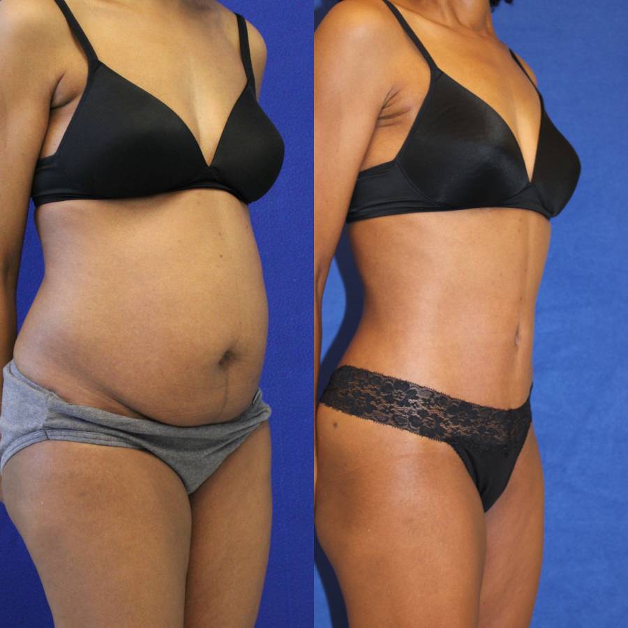 Tummy Tuck (Abdominoplasty) Plus Size Before and After Photos