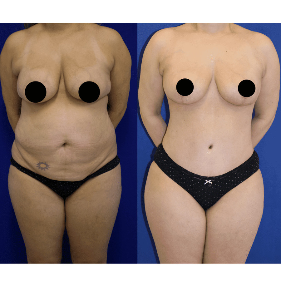 Lift your confidence with Body Lift Surgeries