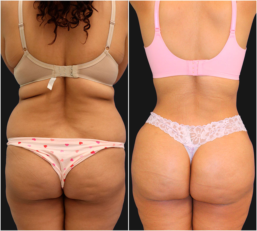 Liposuction of flanks  Care Well Medical Centre