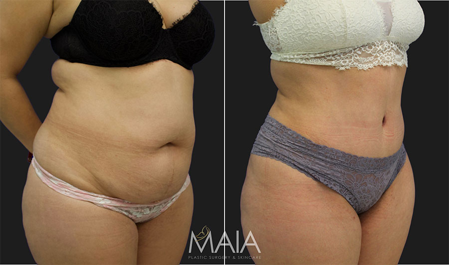 🥇 Liposuction  Maia Plastic Surgery