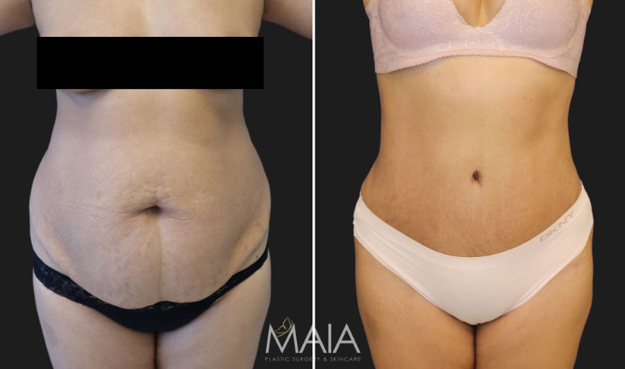 Best Tummy Tuck Before and After -100% Safe & Secure Surgery
