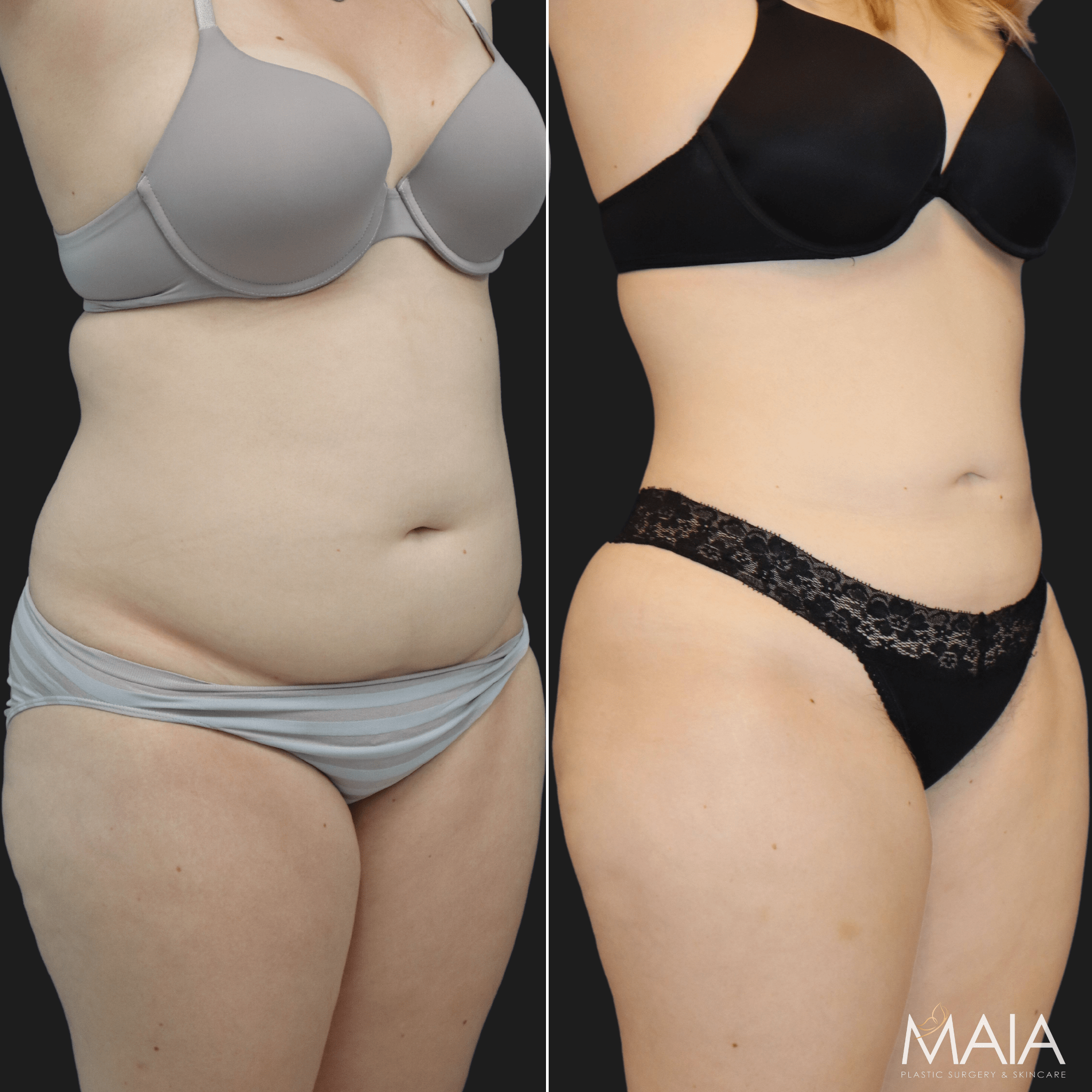 Bra Line and Mid/Upper Back Liposuction