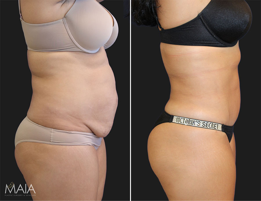 Finn Plastic Surgery - ✨ BEFORE & AFTER ✨ 📝 Tummy tuck with flank  liposuction 📸 6 months post-op This mom of 3 is thrilled with her results!  🤩 A tummy tuck