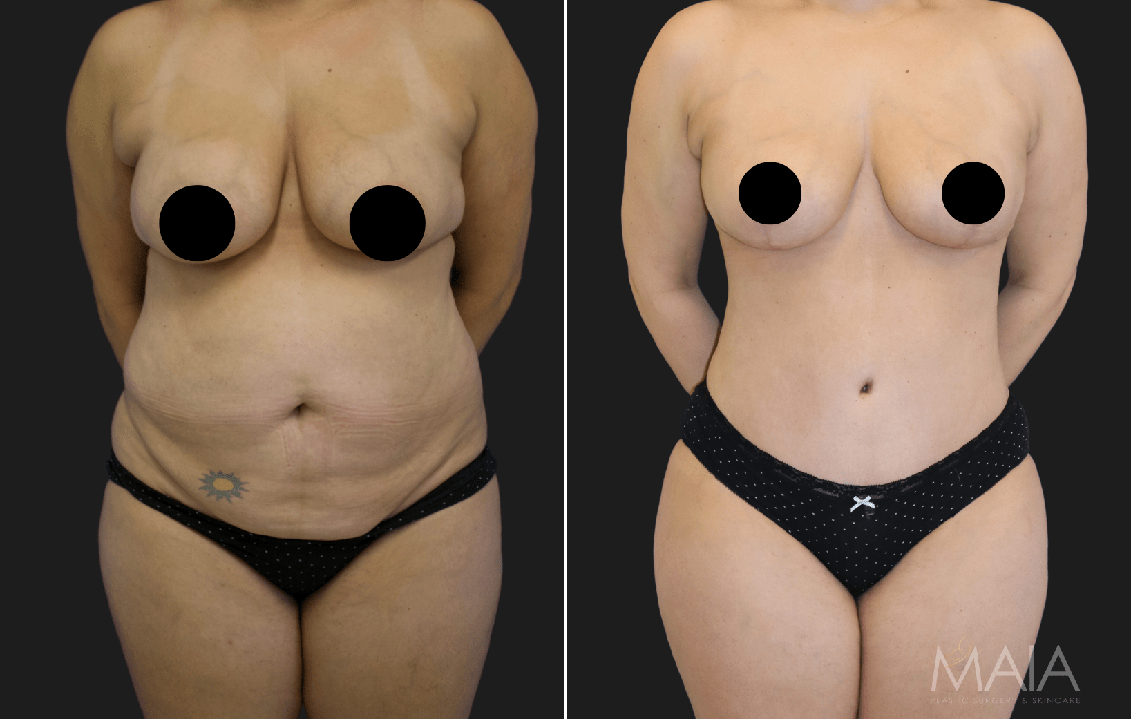 Tummy Tuck & Breast Augmentation Scars 6 Weeks After Surgery