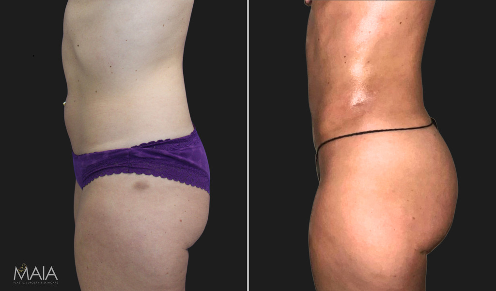 🥇 Can you make a BBL smaller? Why are women seeking liposuction after BBL  (Brazilian butt lift)?