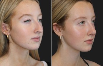 17 year-old patient before and 7 weeks after rhinoplasty