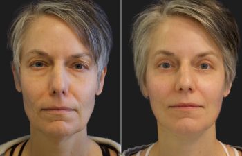 49 year-old before and after Facelift, Necklift, Lower Blepharoplasty, Fat Grafting to Face