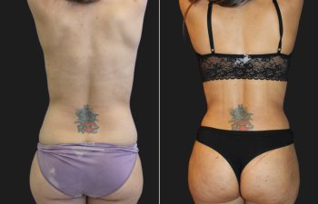 33 year-old before and 7 Weeks After Mommy Makeover (Tummy Tuck; Liposuction of Flanks, Lower Back, Upper Back, Hips, and Arms; Fat grafting to Buttocks; Breast Augmentation w/ Silicone Implants)