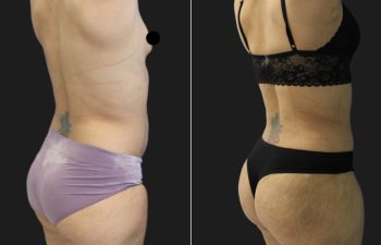 33 year-old before and 7 Weeks After Mommy Makeover (Tummy Tuck; Liposuction of Flanks, Lower Back, Upper Back, Hips, and Arms; Fat grafting to Buttocks; Breast Augmentation w/ Silicone Implants)
