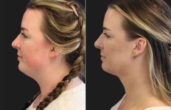 31 year-old bride-to-be before and 6 weeks after awake neck liposuction