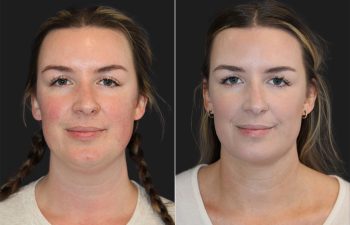 31 year-old bride-to-be before and 6 weeks after awake neck liposuction
