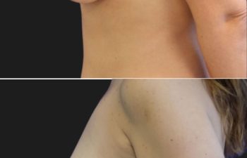 48 year-old before and 3 months after a breast lift