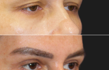 44 year-old before and 11 months after an upper eyelid lift