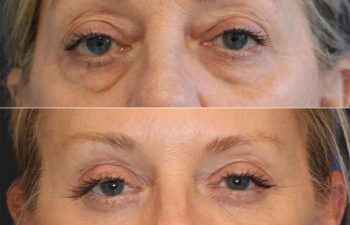61 year-old patient before and after upper and lower blepharoplasty, brow lift, fat grating, and TCA peel