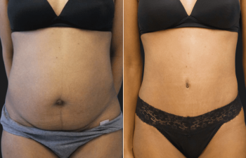 patient before and after abdominoplasty and flanks liposuction