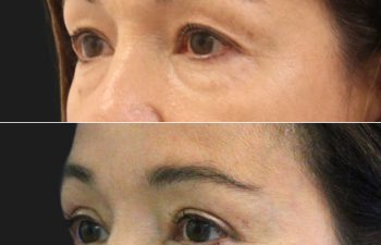 54 year old before and 4 months after upper and lower blepharoplasty