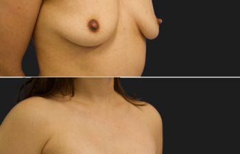 0 year-old before and 17 days after breast augmentation