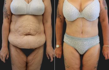 53 year-old before and 1 year after fleur-de-lis tummy tuck, flank liposuction, and thigh lift