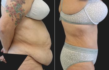 53 year-old before and 1 year after fleur-de-lis tummy tuck, flank liposuction, and thigh lift