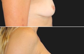 45 year-old before and 2 months after breast augumentation