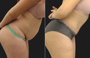 33 year old before and 6 months after a Tummy Tuck, Liposuction of the Flanks, Upper Back and Brazilian Butt Lift BBL Fat Transfer to the Buttocks