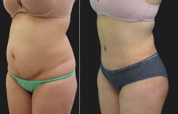 33 year old before and 6 months after a Tummy Tuck, Liposuction of the Flanks, Upper Back and Brazilian Butt Lift BBL Fat Transfer to the Buttocks