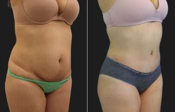 33 year old before and 6 months after a Tummy Tuck, Liposuction of the Flanks, Upper Back and Brazilian Butt Lift BBL Fat Transfer to the Buttocks