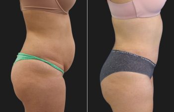 33 year old before and 6 months after a Tummy Tuck, Liposuction of the Flanks, Upper Back and Brazilian Butt Lift BBL Fat Transfer to the Buttocks