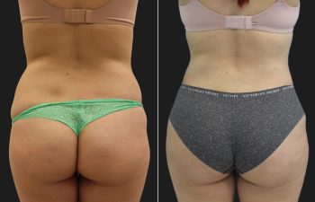 33 year old before and 6 months after a Tummy Tuck, Liposuction of the Flanks, Upper Back and Brazilian Butt Lift BBL Fat Transfer to the Buttocks