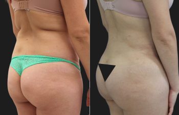 33 year old before and 6 months after a Tummy Tuck, Liposuction of the Flanks, Upper Back and Brazilian Butt Lift BBL Fat Transfer to the Buttocks