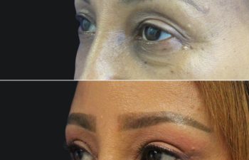 53 year-old before and 2 months after awake upper eyelid lift