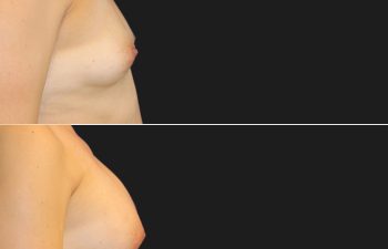 before and after breast augmentation procedure
