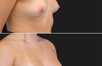 before and after breast augmentation procedure