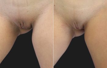 before and after labiaplasty procedure