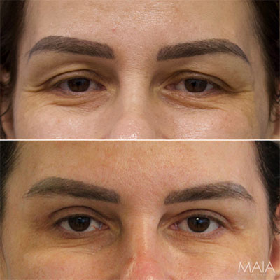 44 year-old before and 11 months after an upper eyelid lift