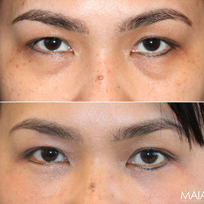 45 year old before and 4 months after lower blepharoplasty