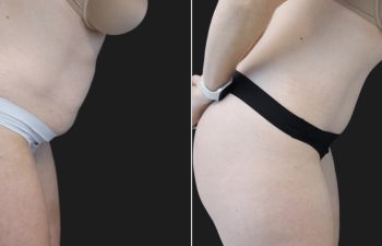 41 year old mother of 3 before and 7 months after abdominoplasty and flank liposuction.