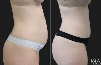 41 year old mother of 3 before and 7 months after abdominoplasty and flank liposuction.