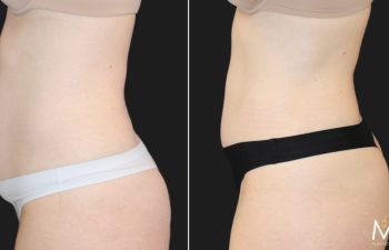 41 year old mother of 3 before and 7 months after abdominoplasty and flank liposuction.