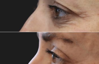 48 year old before and 2 months after awake upper eyelid lift in Tysons Corner, VA