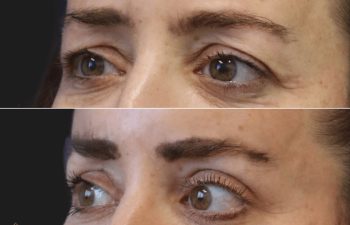 48 year old before and 2 months after awake upper eyelid lift in Tysons Corner, VA