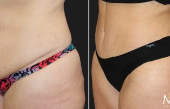 33 year old before and 10 months after abdominoplasty and flank liposuction