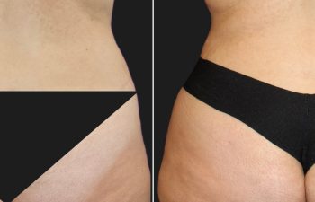 33 year old before and 10 months after abdominoplasty and flank liposuction