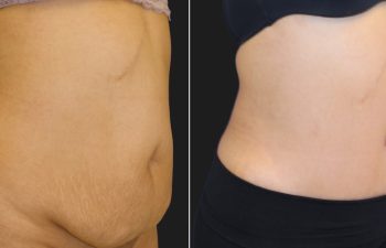 Tummy Tuck after Gallbladder Surgery: 39 year old before and 2 months after tummy tuck and liposuction of the flanks