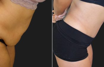 Tummy Tuck after Gallbladder Surgery: 39 year old before and 2 months after tummy tuck and liposuction of the flanks