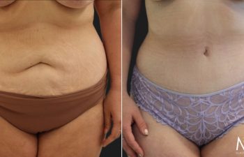 Tummy Tuck after Weight-Loss: 29 year old before and 5 months after an extended tummy tuck and breast lift