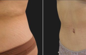 Tummy Tuck after Weight-Loss: 29 year old before and 5 months after an extended tummy tuck and breast lift