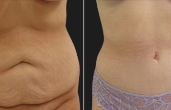 Tummy Tuck after Weight-Loss: 29 year old before and 5 months after an extended tummy tuck and breast lift