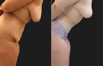 Tummy Tuck after Weight-Loss: 29 year old before and 5 months after an extended tummy tuck and breast lift